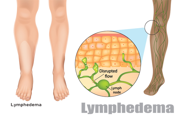 Cirugía de linfedema